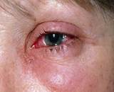 http://www.minsksanepid.by/sites/default/files/tularemia-1.jpg